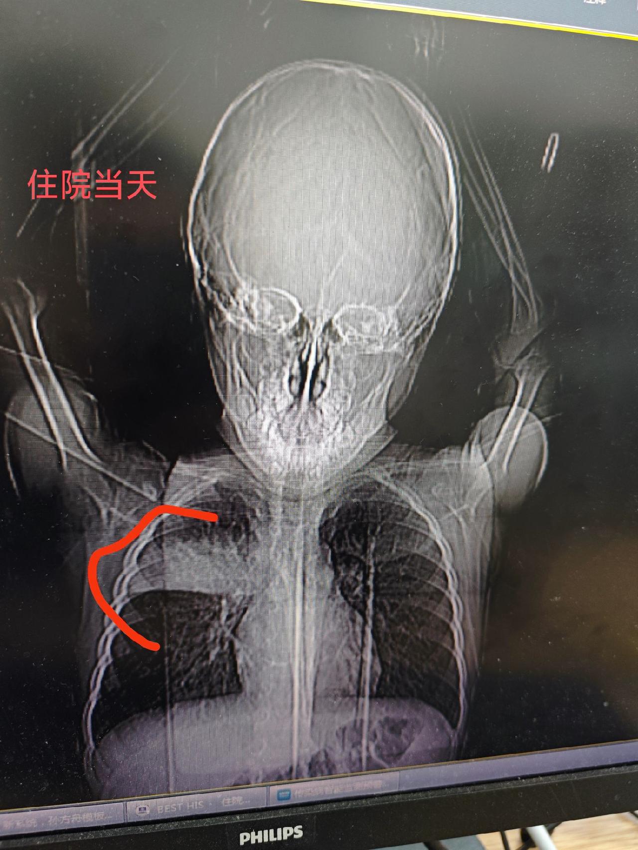 【新疆肺炎/新疆确诊肺炎】-第3张图片